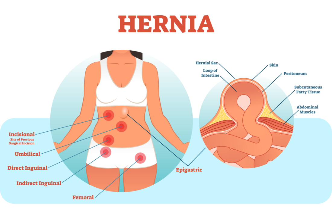 Inguinal Hernia